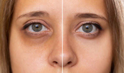 Under Eye Dark Circles ke effective solutions